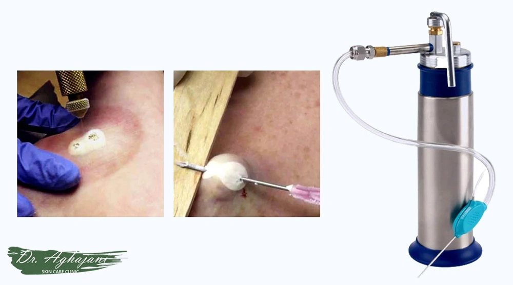 کرایوتراپی داخل ضایعه