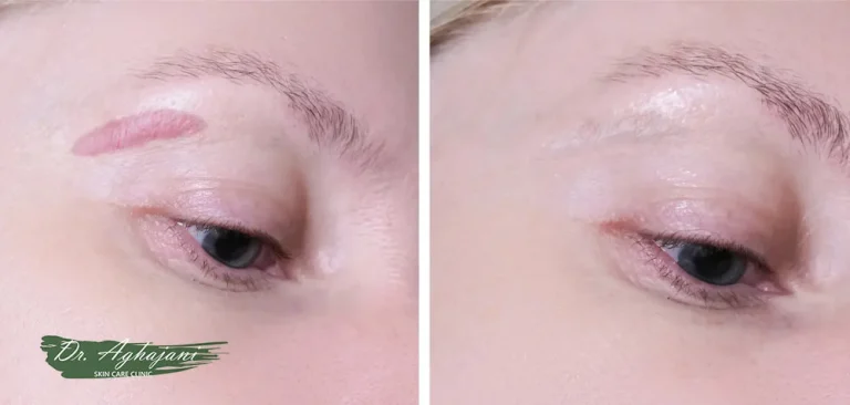 لیزر جای زخم و بخیه