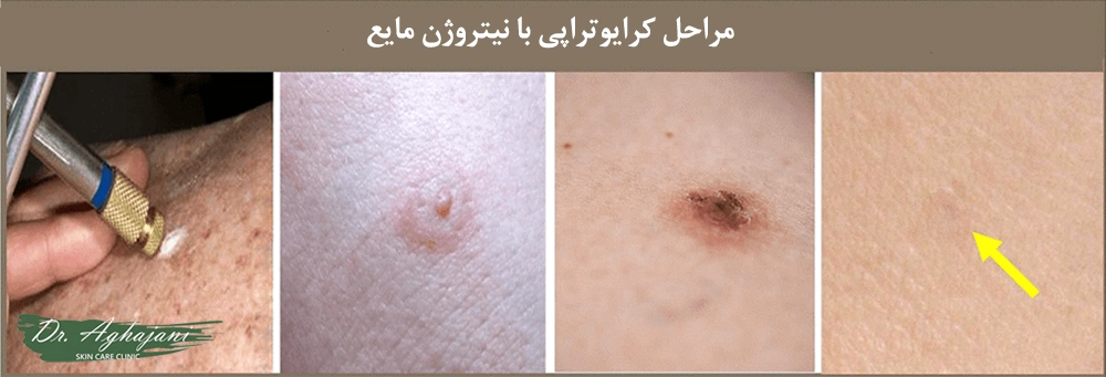 مراحل کرایوتراپی با نیتروژن مایع