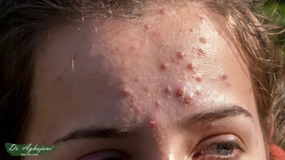 درمان تخصصی جوش‌های التهابی شدید