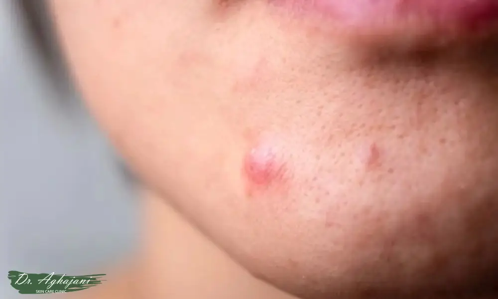 جوش‌های التهابی غیرشدید 