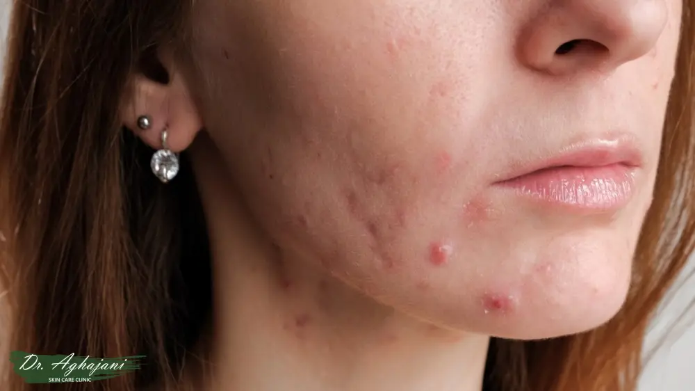 جوش التهابی بدون عفونت