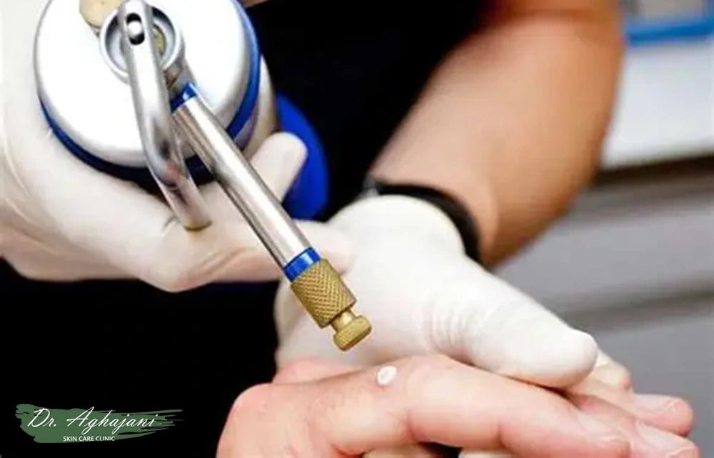 کرایوتراپی سطحی