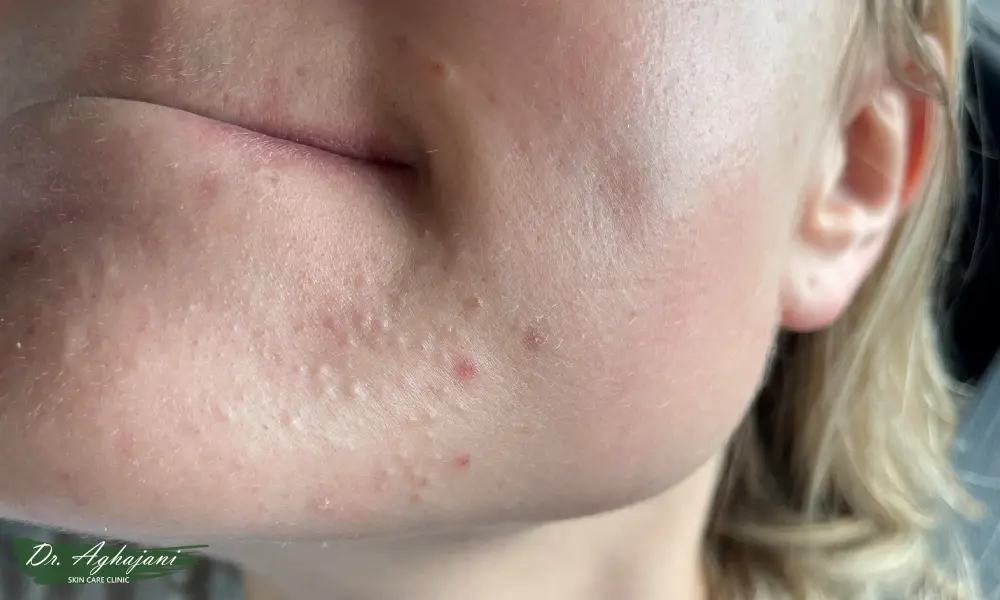 جوش‌های سرسفید پراکنده و کم 