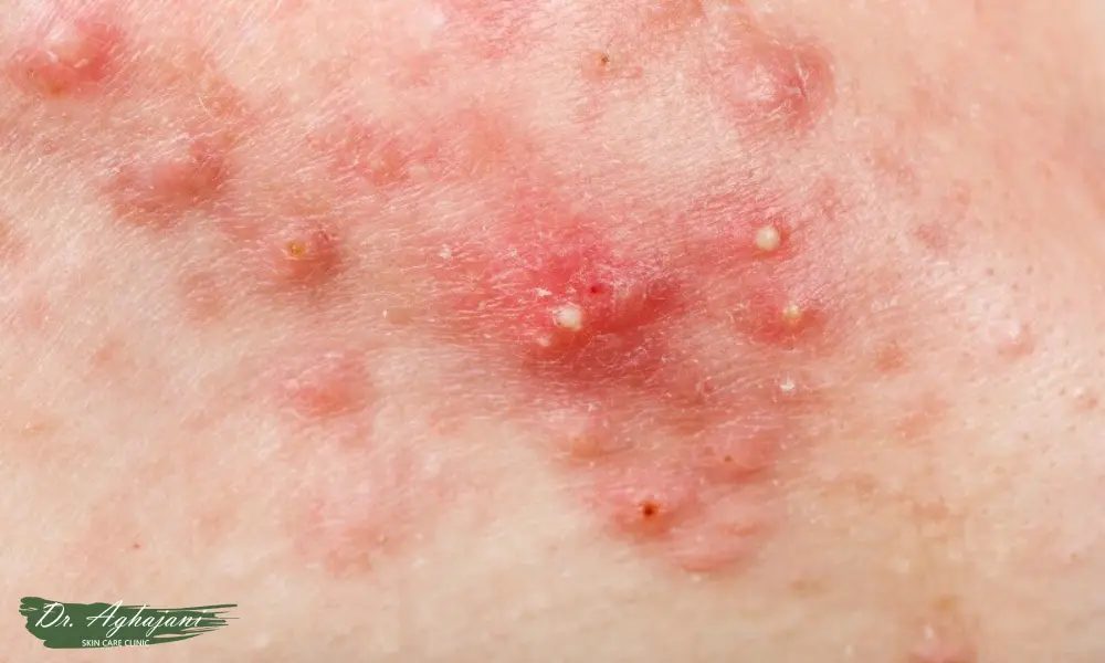 کاهش چرک و مهار عفونت