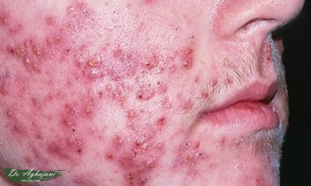 جوش‌های التهابی شدید و گسترده