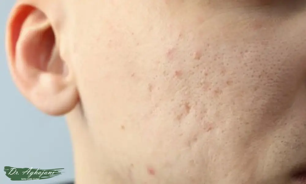 جوش‌های سر سفید غیرالتهابی