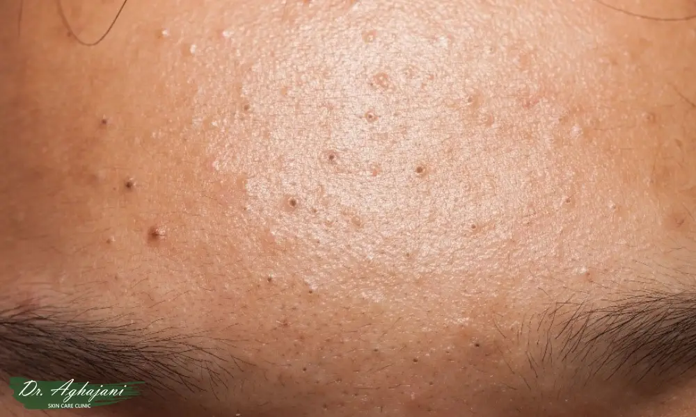 جوش‌های سرسیاه