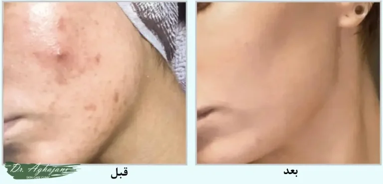 درمان جای جوش