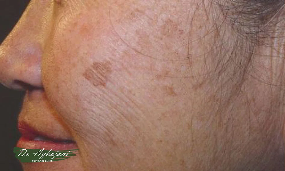 لکهای سطحی و کمرنگ