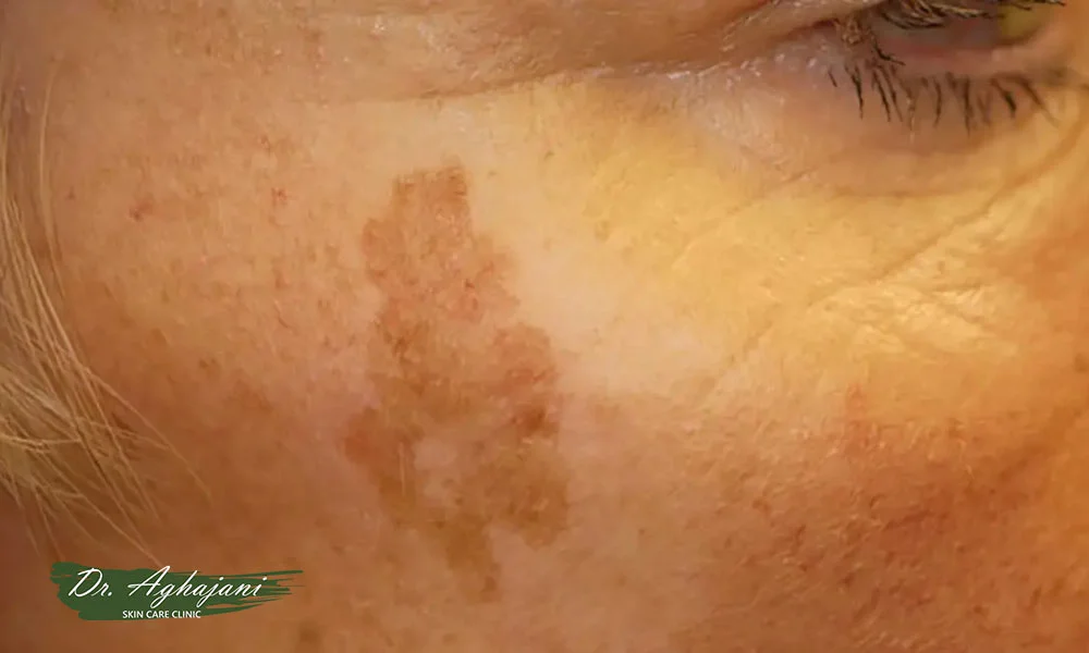 تصاویر لکهای سطحی