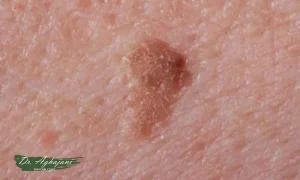 لکهای تیرهرنگ