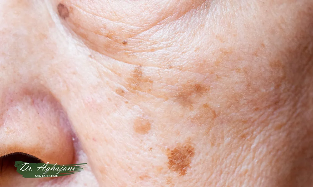 لکهای تیرهرنگ