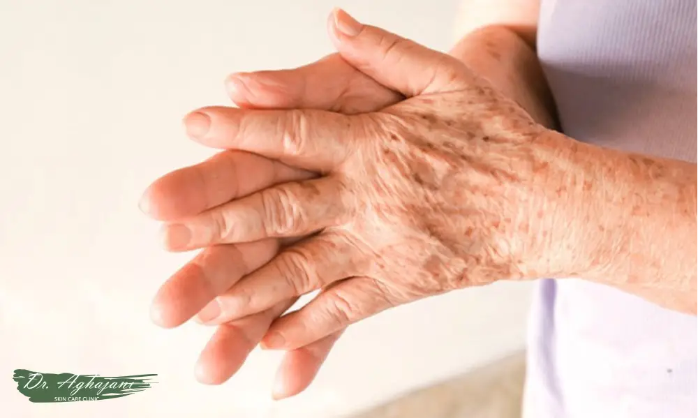 لک گرد یا بیضی با مرز مشخص