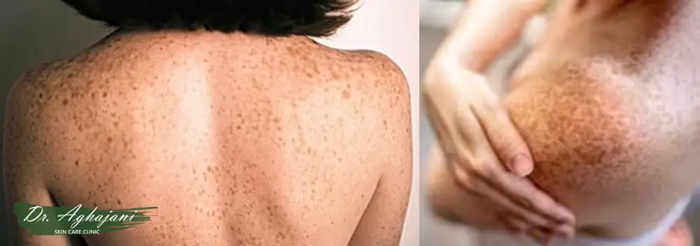 لکهای ریز و متعدد (ککومک)