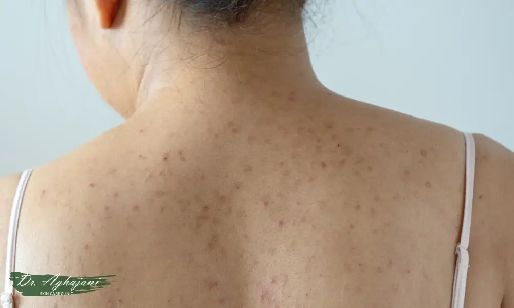 لکهای نامنظم روی جای جوش