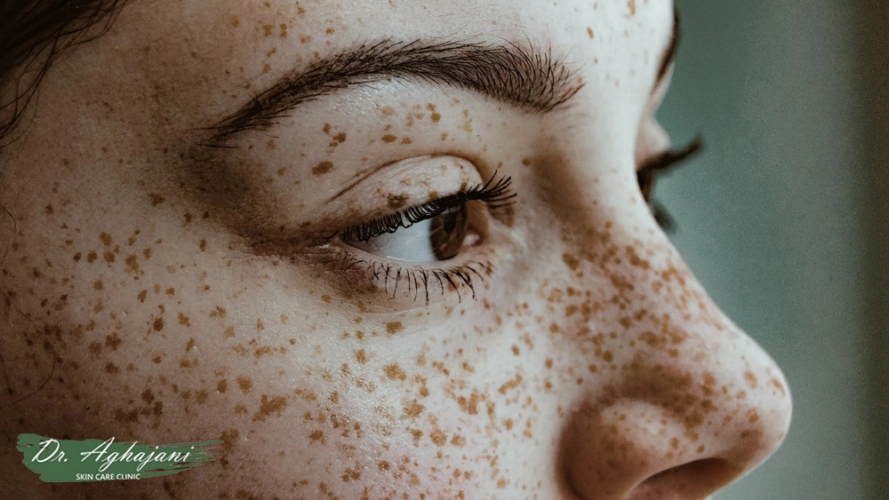 درمان قطعی کک و مک صورت