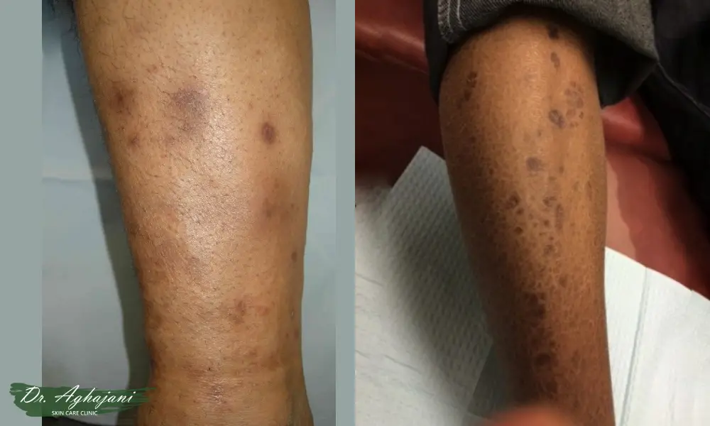 لکهای تیره پراکنده در ساق پا