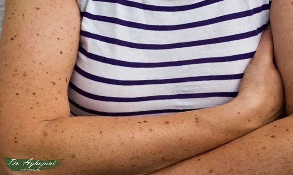 لکهای ریز شبیه ککومک