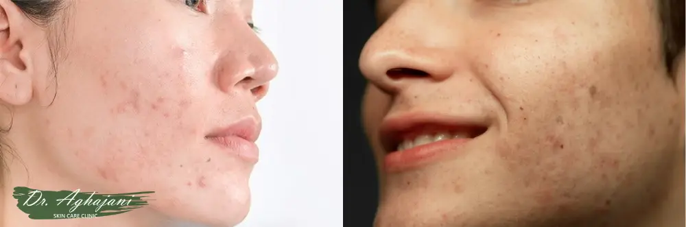 لکهای تیره روی جای جوش