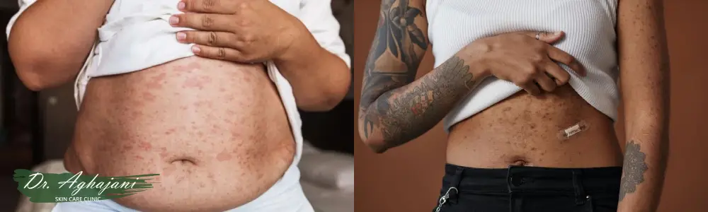 لکه های قهوه ای در ناحیه شکم