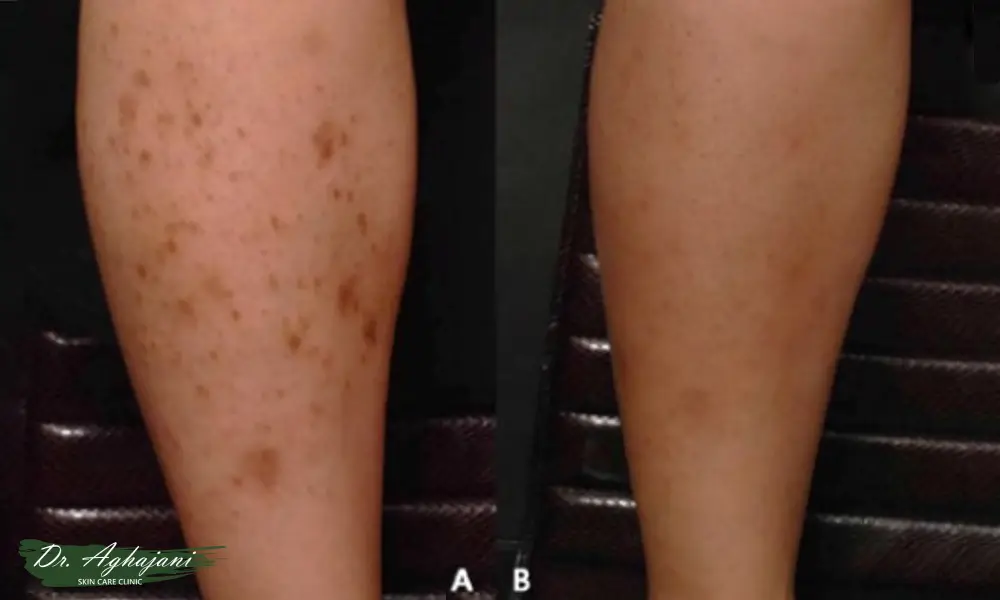 لک تیره روی جای زخم یا نیش حشرات