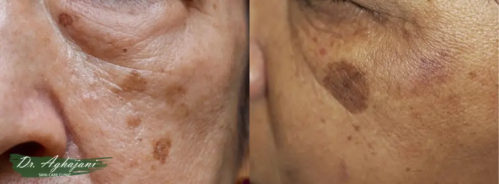 لکههای قهوهای پهن