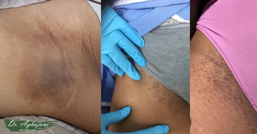 لکههای قهوهای ناحیه تناسلی و کشاله ران