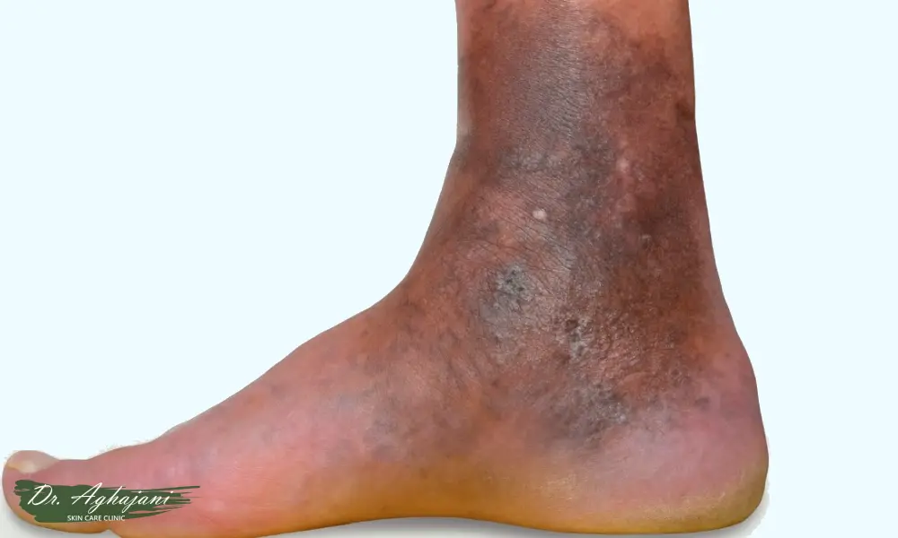 لک قهوهای پخش نزدیک مچ پا