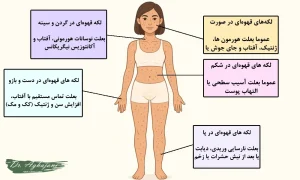 لکههای پوستی قهوهای