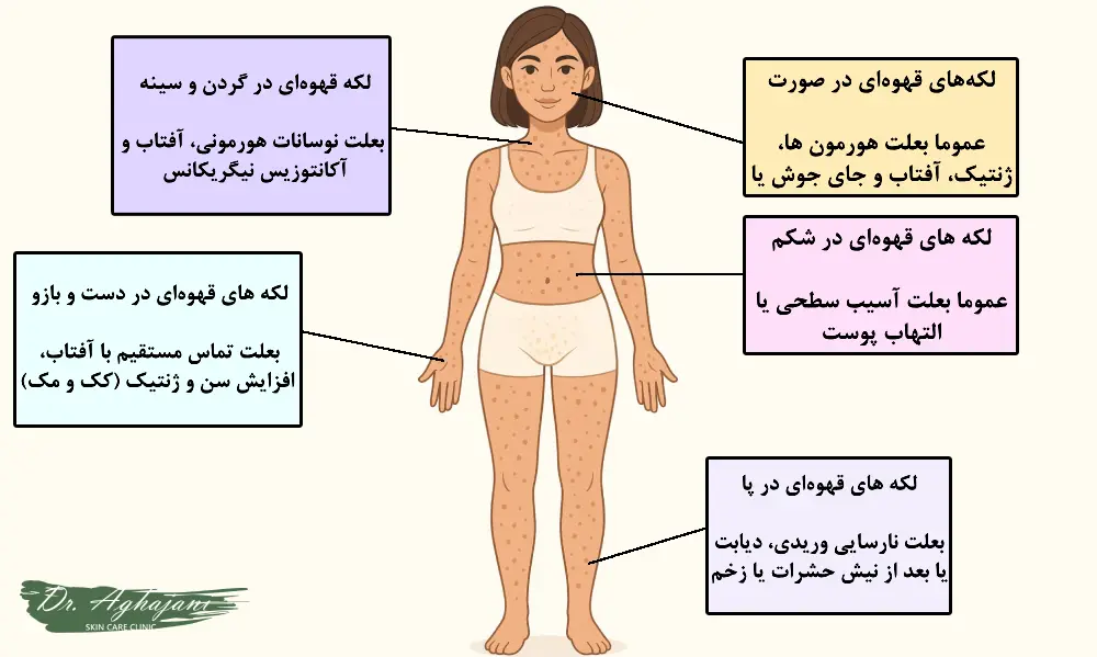 لکههای پوستی قهوهای