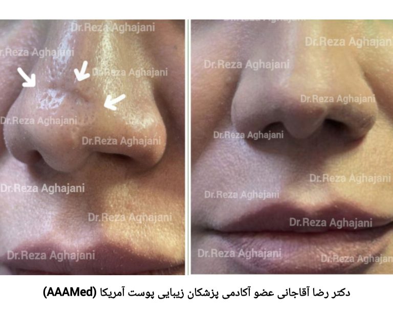 اسکار فرورفتگی
