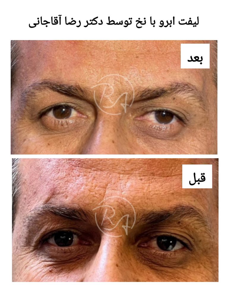 لیفت ابرو با نخ