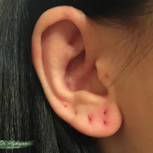 اسکار آتروفیک