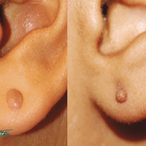 اسکار هیپرتروفیک