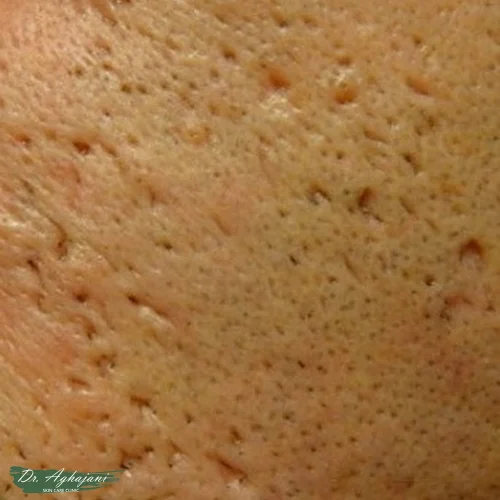 اسکارهای آیس‌پیک