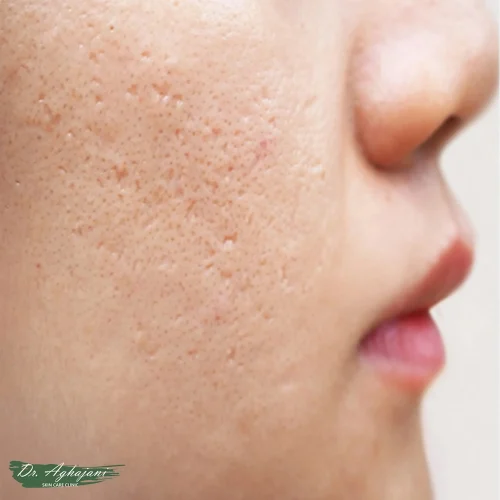 اسکارهای آیس‌پیک