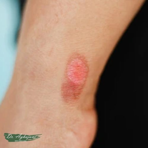 درمان فوری جای زخم سوختگی تازه