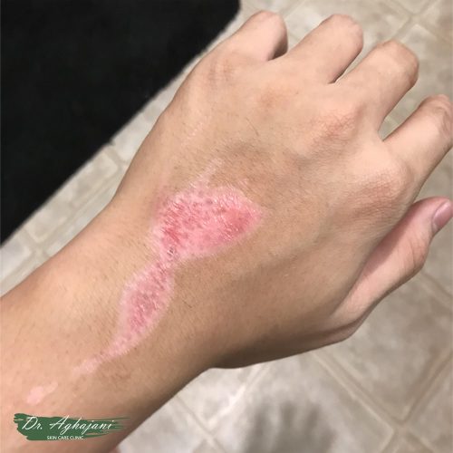 درمان فوری جای زخم سوختگی تازه