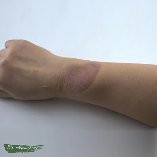 اسکار با تغییر رنگ