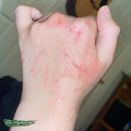 اسکار با تغییر رنگ