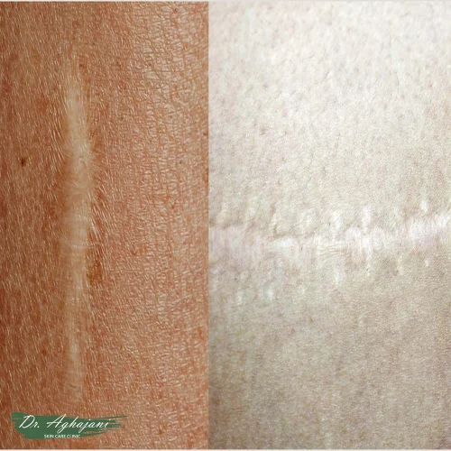 اسکار با تغییر رنگ (لک‌های پوستی)