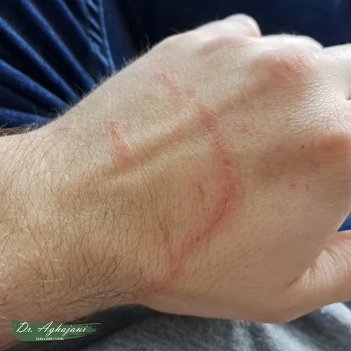 اسکار با تغییر رنگ